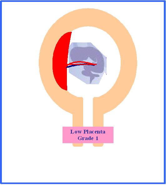 Placenta Praevia Grade one Dr Youssif